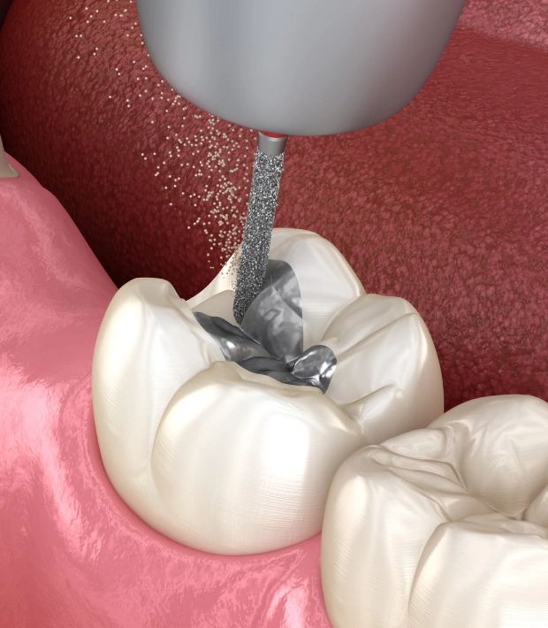 Illustration of a mercury-free dental filling being placed