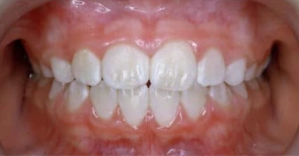 Front teeth showing an open bite