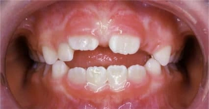 Front teeth showing an open bite with visible gap
