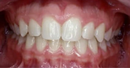 Front teeth showing an overbite after treatment