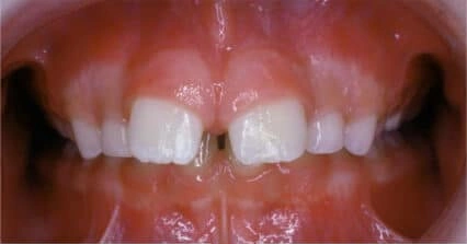 Front teeth showing an overbite before treatment