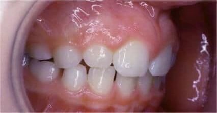 Lower teeth showing an developed jaw