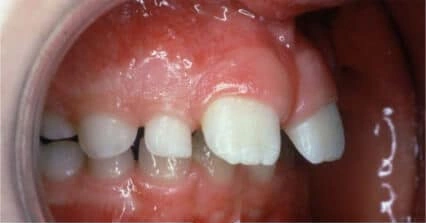 Lower teeth showing an underdeveloped jaw