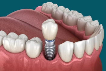 Dental implant supporting a single replacement tooth