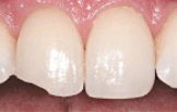 Teeth before tooth bonding treatment