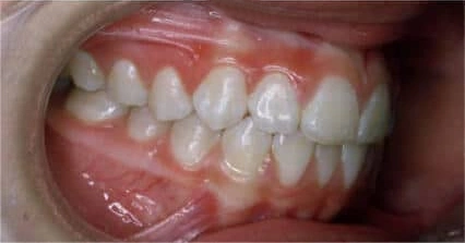 Lower teeth showing jaw correction after treatment