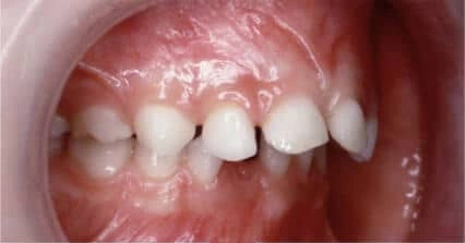 Lower teeth showing an underdeveloped jaw before treatment