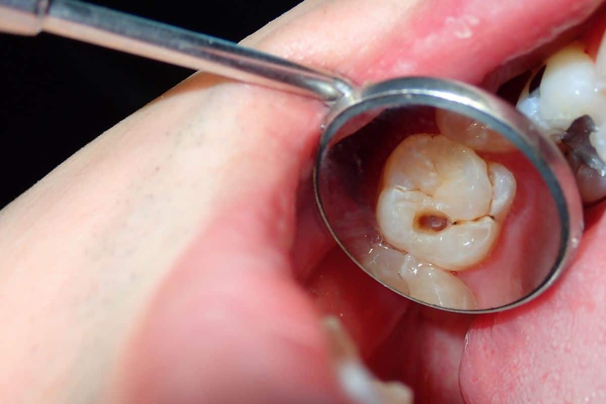 saliva-flow-age-cavity-risk