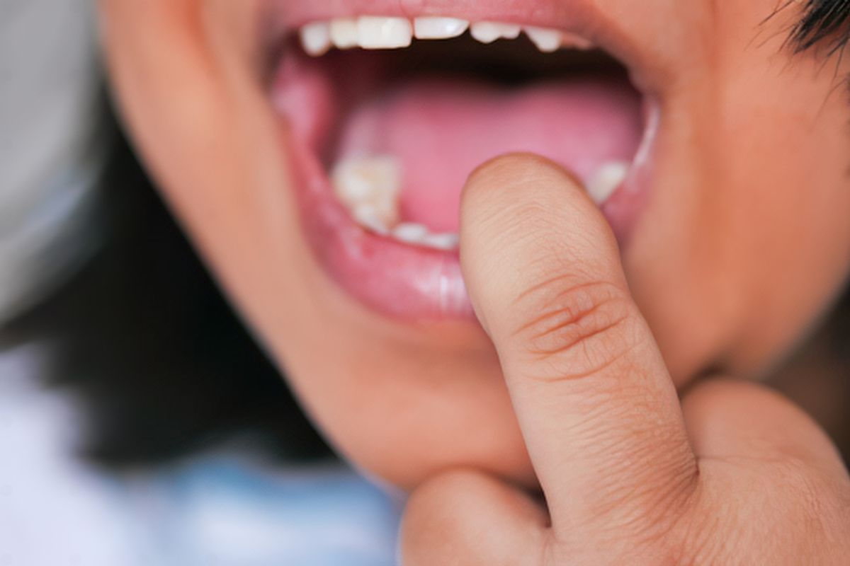 Close-up of a person pointing to their back teeth, illustrating how a dental cavity can develop without noticeable tooth pain.