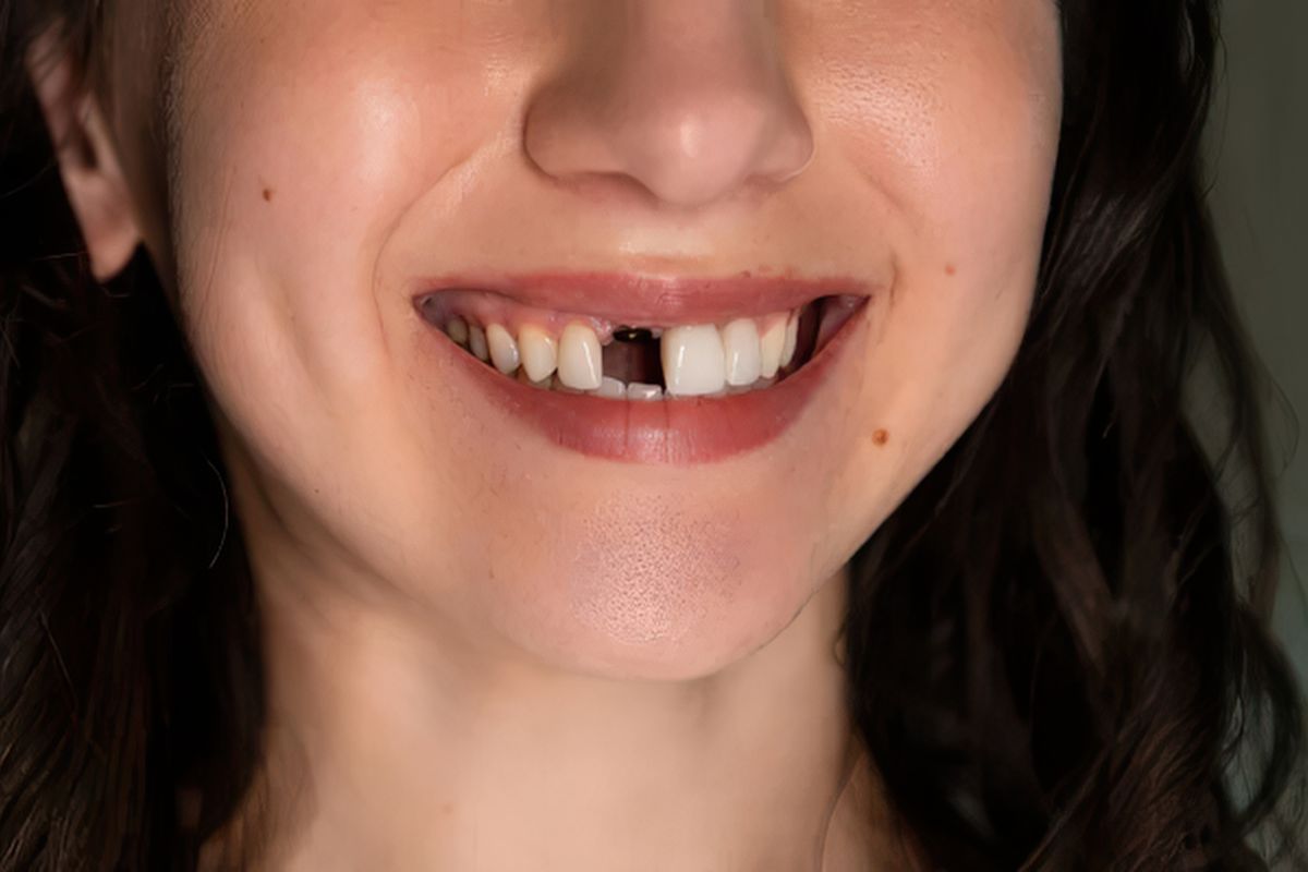 Close-up of a woman smiling with a missing upper front tooth, illustrating the impact of tooth loss on appearance and dental function.